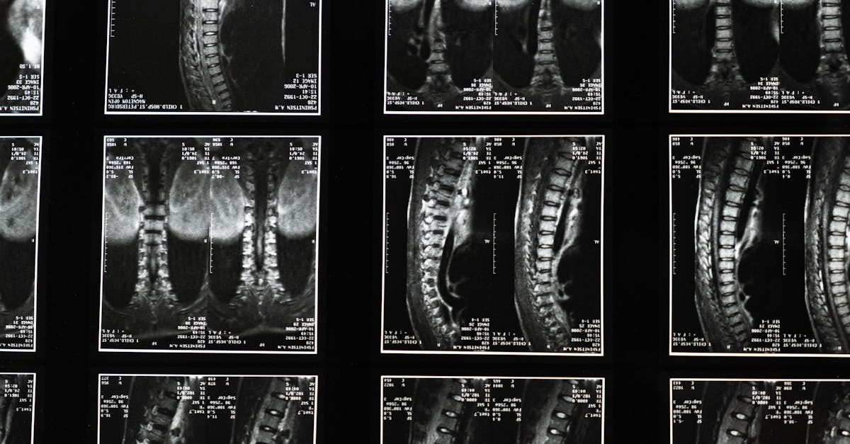 découvrez les causes, symptômes et traitements des spasmes cervicaux. apprenez à soulager cette condition douloureuse et à améliorer votre bien-être grâce à des conseils pratiques et des approches thérapeutiques.