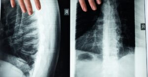 découvrez tout ce qu'il faut savoir sur la colonne thoracique : anatomie, fonctions, pathologies et traitements. optimisez votre santé vertébrale et apprenez à soulager les douleurs thoraciques avec nos conseils d'experts.