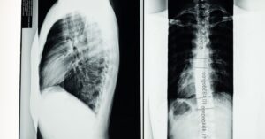 découvrez tout sur la scoliose : causes, symptômes, traitements et conseils pour vivre avec cette condition. informez-vous sur les meilleures pratiques pour maintenir une bonne santé vertébrale.