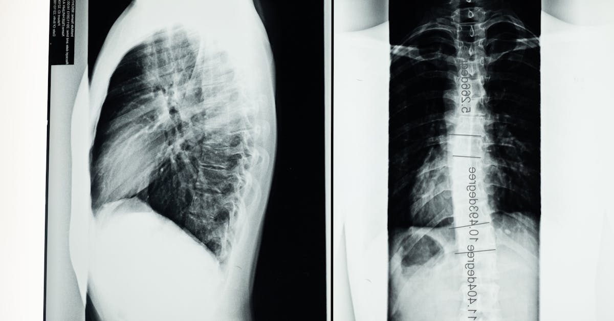 découvrez tout sur la scoliose : causes, symptômes, traitements et conseils pour vivre avec cette condition. informez-vous sur les meilleures pratiques pour maintenir une bonne santé vertébrale.