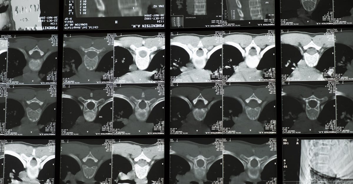 découvrez tout ce que vous devez savoir sur la scoliose : causes, symptômes, diagnostic et traitements disponibles. informez-vous sur cette déformation de la colonne vertébrale et explorez les options pour améliorer votre qualité de vie.